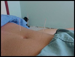 acupuntura-para-adelgazar1