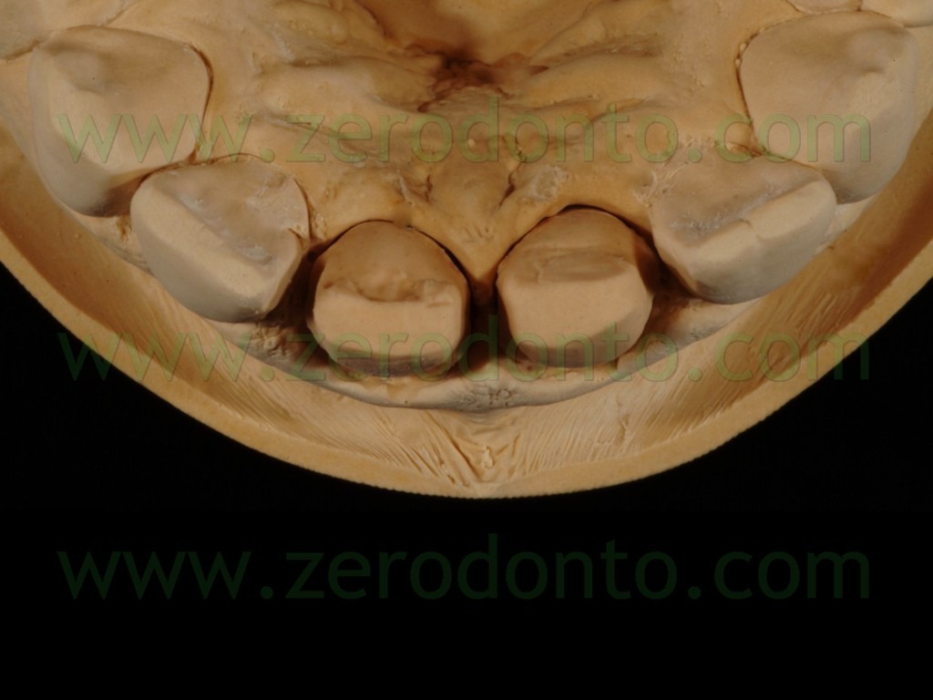 [85-tecnica-butt-joint-faccette3.jpg]