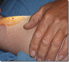 fish-hook in leg 05-24-11 002 fish-hook in leg 05-24-11 002