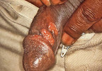 pene_Treponema_pallidum.jpg