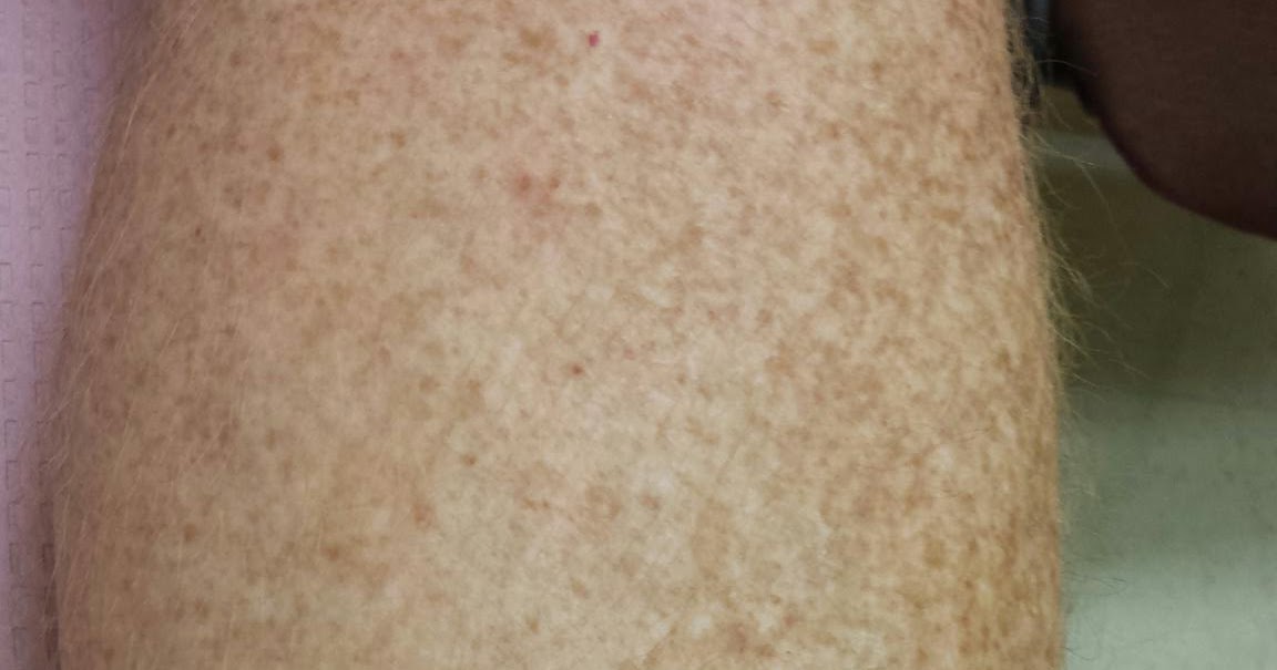 Dr. K. Lam Straight Talk Malignant Melanoma on the Leg at www