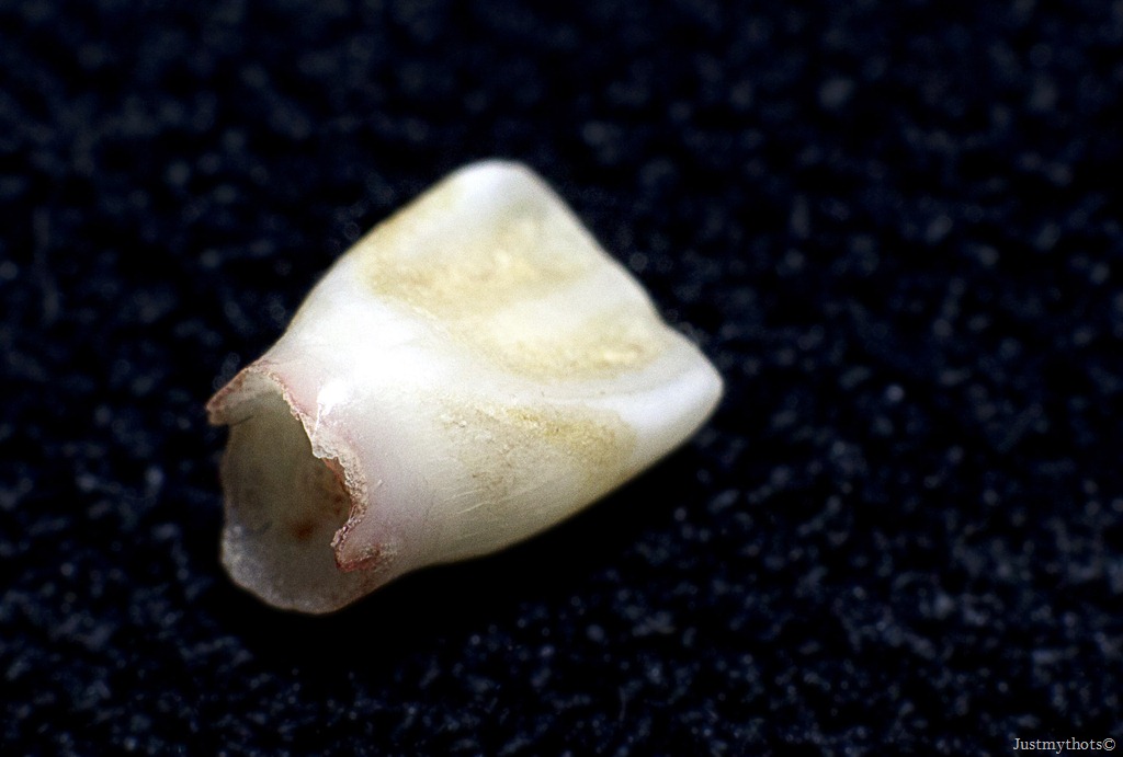 [Tooth%255B3%255D.jpg]