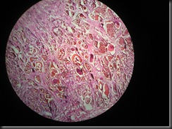 hemangioma high resolution histology slide tsnaps hemangioma high resolution histology slide tsnaps