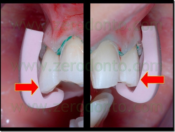 58 spessore preparazione margine incisale faccette
