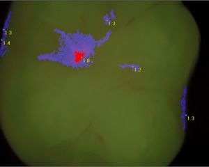 Molar 2.jpg
