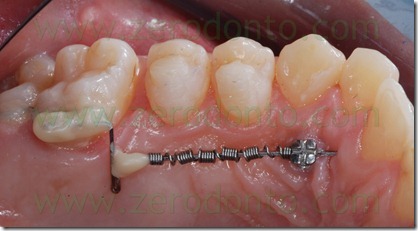 23 sistema per distalizzare i molari 23 sistema per distalizzare i molari