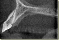 CT Palatal Resorption003