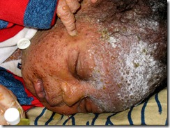 Newborn with Chickenpox