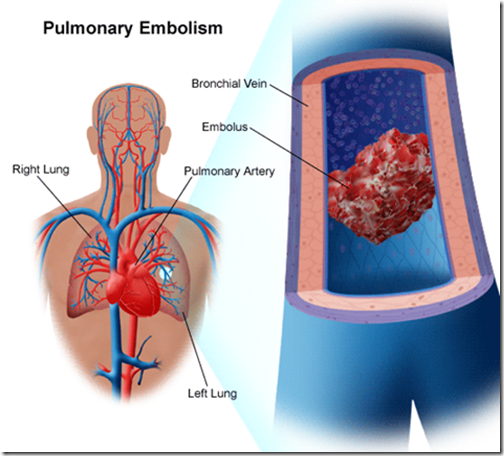 cervical incompetence icd 10 endometrial cancer danger is higher than average for