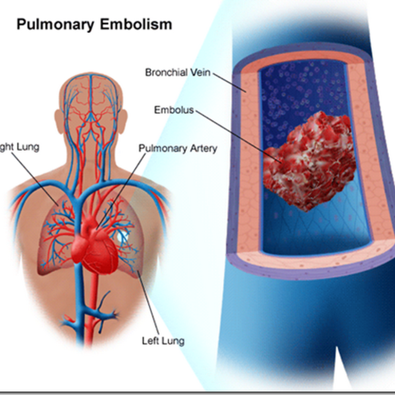 MR Detection of Pulmonary Embolism - New Approach