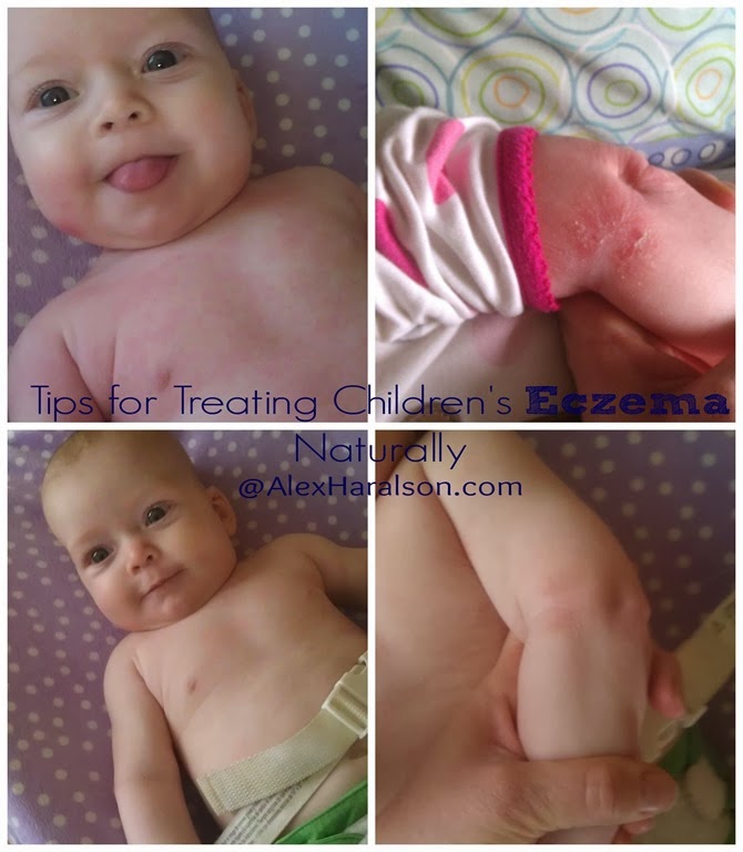 [tips-for-treating-childrens-eczema-n.jpg]