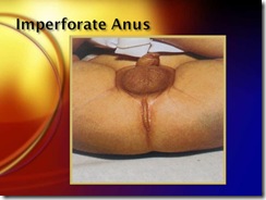 imperforate anus medicalshow