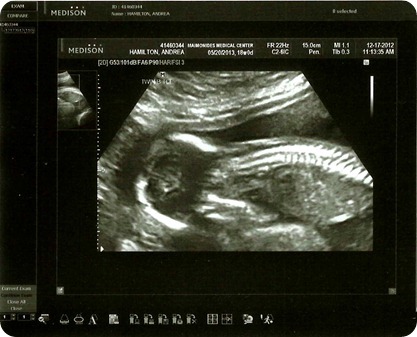 Twin B Baby Boy Spine 18 Weeks