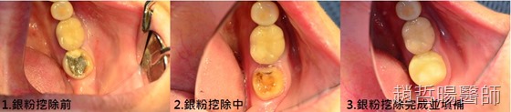 排汞圖 排汞圖