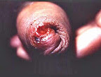 cabeza-pene-con-sifilis.jpg