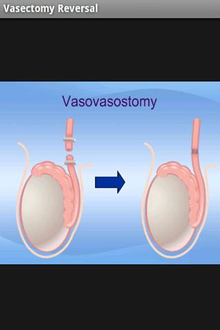 Vasectomy Reversal