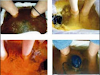 Terapia De Desintoxicacion Ionica