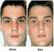 Tratamiento De Acne Puntos Negros Piel Grasa