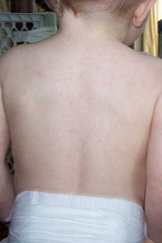 [rash2[4].jpg]