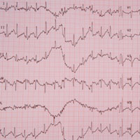 Cardiac Rhythm Abnormalities