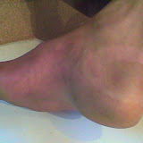 Rotura de tend�o e ligamento plantar - �lbum do Picasa