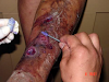 Glustitch