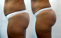 Implantes De Gluteo 1000 Cc Por 3000 Bs