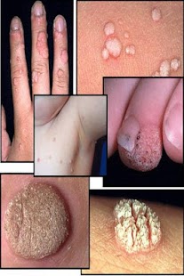How to get Get Rid Of Warts lastet apk for pc