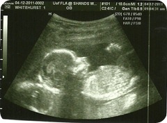 Baby 1 Profile @ 17 weeks Baby 1 Profile @ 17 weeks