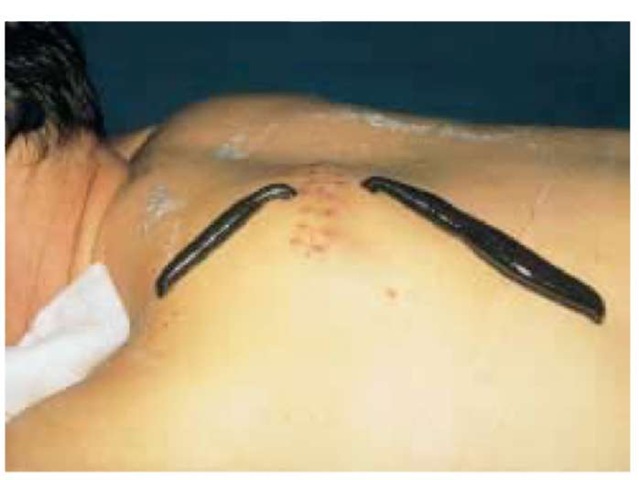 Use of the medicinal leech (Hirudo medicinalis) in the treatment of haemotoma, an accumulation of blood within the tissues that clots to form a solid swelling.