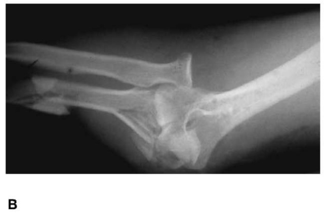(B) This patient sustained a comminuted fracture of the proximal and midshaft ulna as well as a radial head dislocation from impact with the module cover.