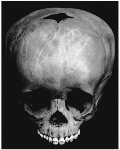 Possible hydrocephalus in a 3-year-old child (Pretoria skeletal collection). 