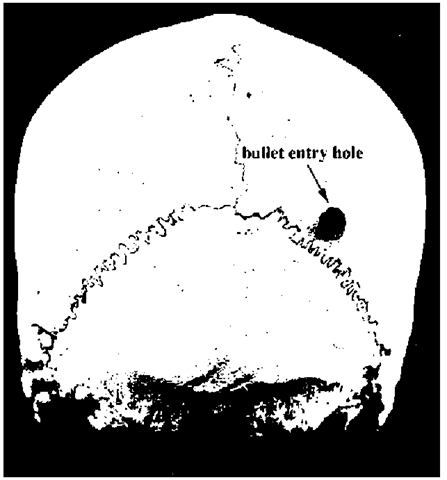 Bullet damage to the rear of a skull. The opening in the inside is much larger and reflects a cone-shaped defect.