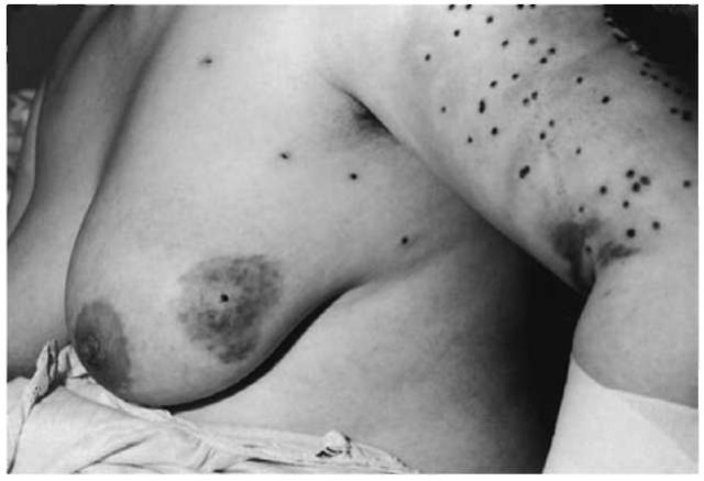 Surviving victim with numerous pellet injuries of the left upper arm and breast from a distant twelve-bore shotgun discharge without penetration of the thoracic wall.