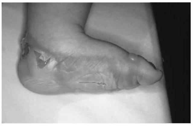 When a child's foot is immersed in a hot liquid, a line of demarcation results. This patient had symmetrical burns on her right and left feet.