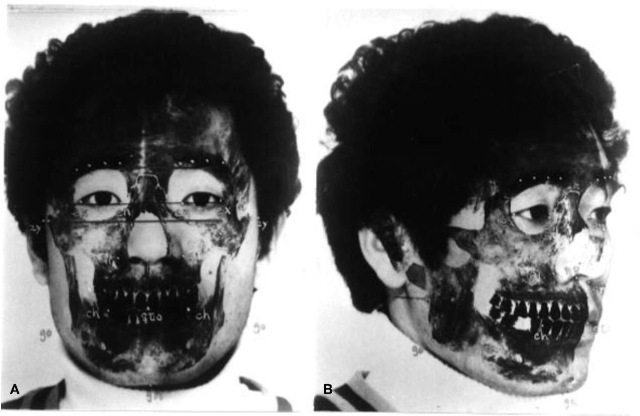 (A) Frontal and (B) oblique photographic superimposition images, showing a good match between skull and facial photographs. 