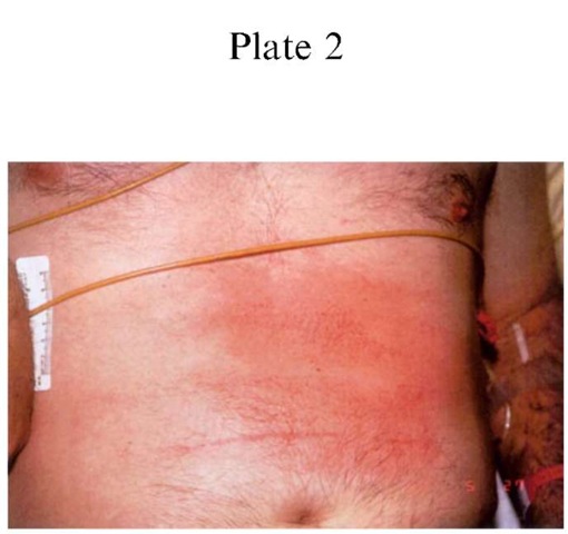 Plate 2 ACCIDENT INVESTIGATION/Driver Versus Passenger in Motor Vehicle Collisions Contact with deploying air bags will result in injuries to the occupants, including abrasions. This patient sustained superficial abrasions overlying the abdomen, secondary to air bag deployment. Such injuries can be matched to the vehicle's air bag.