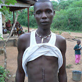  &ndash; Abu showing scar from ulcer surgery (picture taken by James Mansaray)