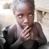  &ndash; Child with what looks to be corneal decomposition; she is blind. ©2007 NHA JMansaray photographer
