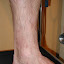 Eczema2 Post-op.JPG
