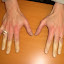 raynaud1.jpg