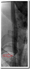 RIJV angiogram 01 RIJV angiogram 01