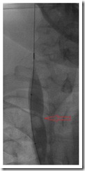 RIJV partial inflate 01 RIJV partial inflate 01