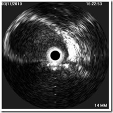 IVUS rest LIJV IVUS rest LIJV