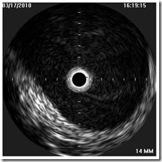 IVUS inspiration LIJV IVUS inspiration LIJV