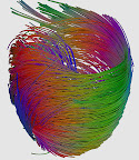 Patrick Hales
Universidad de Oxford
Esta imagen obtenida mediante resonancia magnética muestra el movimiento de las moléculas de agua en el músculo cardiaco, y muestra la alineación de las células fibrosas en el ventrículo izquierdo. "Esta tecnología permite modelar la estructura del corazón de un modo no invasivo. En el futuro, podríamos observar cómo un infarto daña esta estructura y cómo reaccionan las fibras musculares", explica el autor de la imagen. Patrick Hales
Universidad de Oxford
Esta imagen obtenida mediante resonancia magnética muestra el movimiento de las moléculas de agua en el músculo cardiaco, y muestra la alineación de las células fibrosas en el ventrículo izquierdo. "Esta tecnología permite modelar la estructura del corazón de un modo no invasivo. En el futuro, podríamos observar cómo un infarto daña esta estructura y cómo reaccionan las fibras musculares", explica el autor de la imagen.