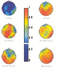Régulation de l'activité cérébrale pendant le SK. Naga Venkatesha Murthy, P.J., Janakiramaiah, N., Gangadhar, B.N., Subbakrishna, D.K. (1998) - Journal of Affective Disorders. 50(1):45-8.