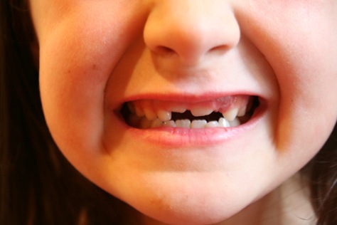 [KyliesLostTooth-4[2].jpg]