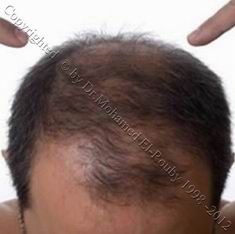 hair losser hair losser
