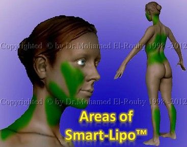areas of smart liposuction areas of smart liposuction